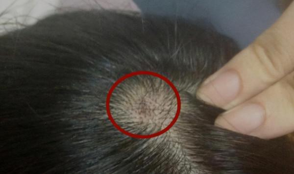為什麼頭皮總長“疙瘩”和“膿包”？或與4個原因有關