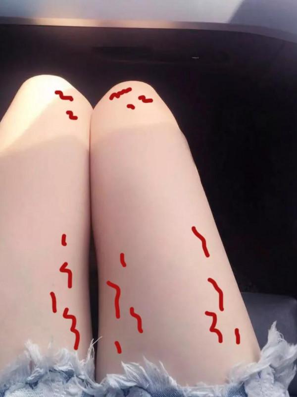 有肥胖紋的姐妹快來看啊！終於找到可以淡化肥胖紋的方法了