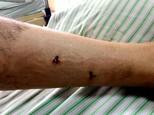 傷口老不癒合 傷口老不癒合