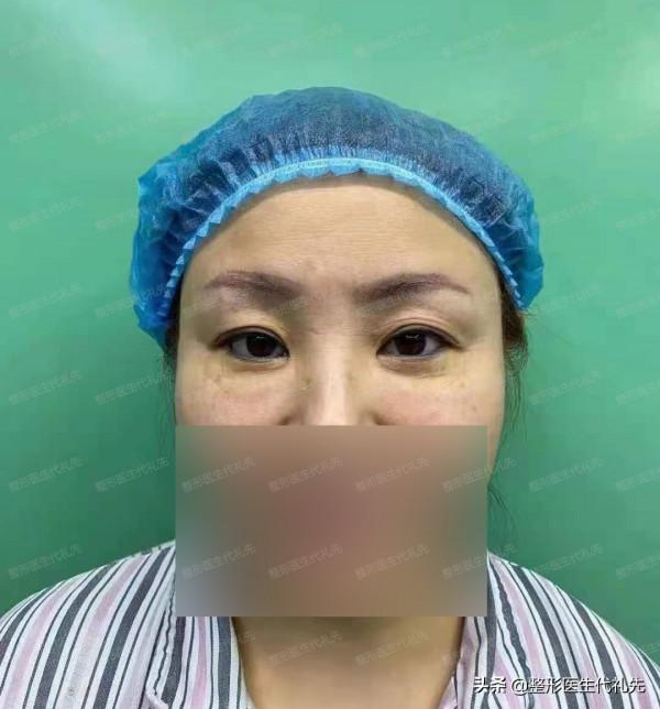 說一說我在北京做“眼周年輕化手術”的親身經歷和感受