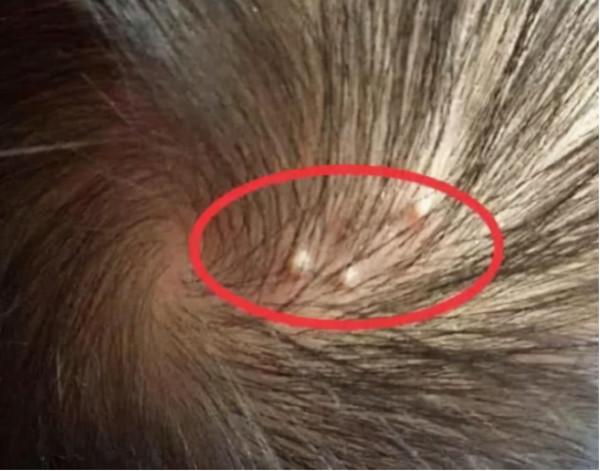 為什麼頭皮老是長疙瘩？或與這3種病有關