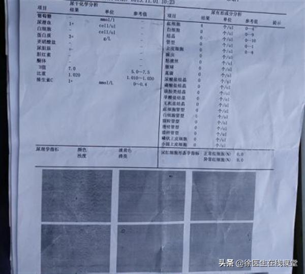 35歲女子雙腳水腫,診斷腎病綜合徵,出現咳嗽時醫生才發現是肺癌 35歲女子雙腳水腫,診斷腎病綜合徵,出現咳嗽時醫生才發現是肺癌