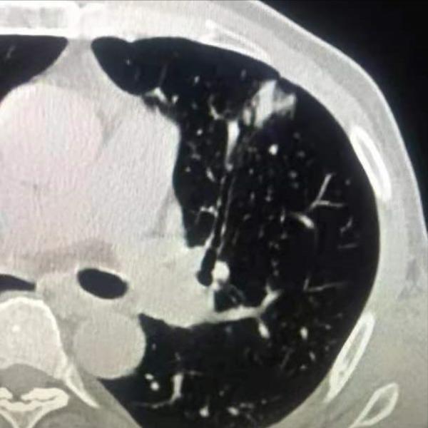 肺腺癌轉移快嗎?相比較肺鱗癌,的確更容易發生遠處轉移 肺腺癌轉移快嗎?相比較肺鱗癌,的確更容易發生遠處轉移