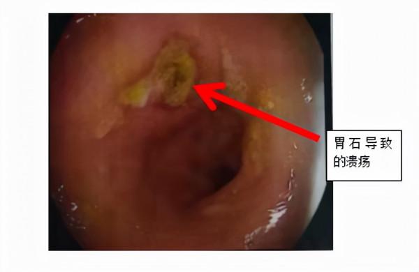 冬天來了,你的胃還好嗎? 冬天來了,你的胃還好嗎?
