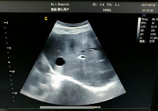 體檢時查出這4種病，或無需過度治療，不要自己嚇唬自己