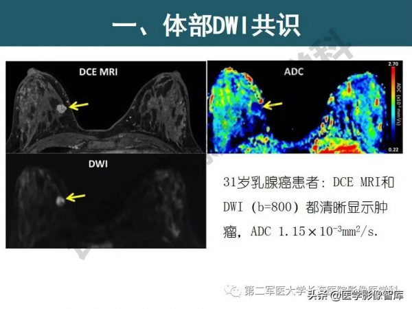 體部DWI共識及胰腺DWI研究經驗介紹