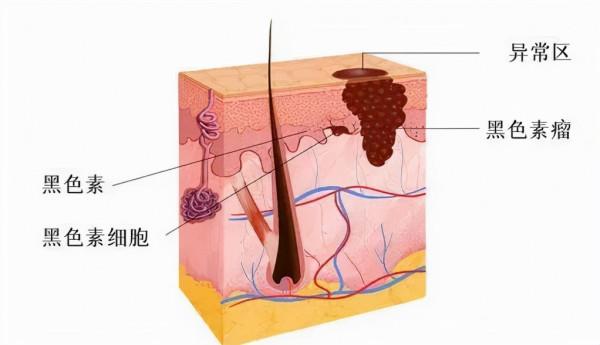 腳底板一顆黑痣原來是癌!長了痣要不要切?“ABCDE法”自測危險程度 腳底板一顆黑痣原來是癌!長了痣要不要切?“ABCDE法”自測危險程度