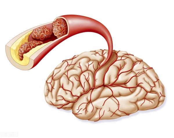 血栓來臨手腳先知！醫生提醒：手腳出現3種症狀，或許血栓已來臨