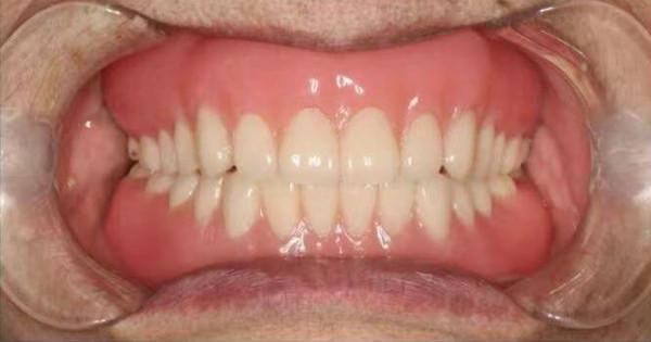 當天搞定,她“長”出滿口新牙 當天搞定,她“長”出滿口新牙