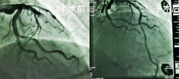 與時間賽跑!省前衛醫院為一名廣泛前壁心肌梗死患者重獲新生 與時間賽跑!省前衛醫院為一名廣泛前壁心肌梗死患者重獲新生
