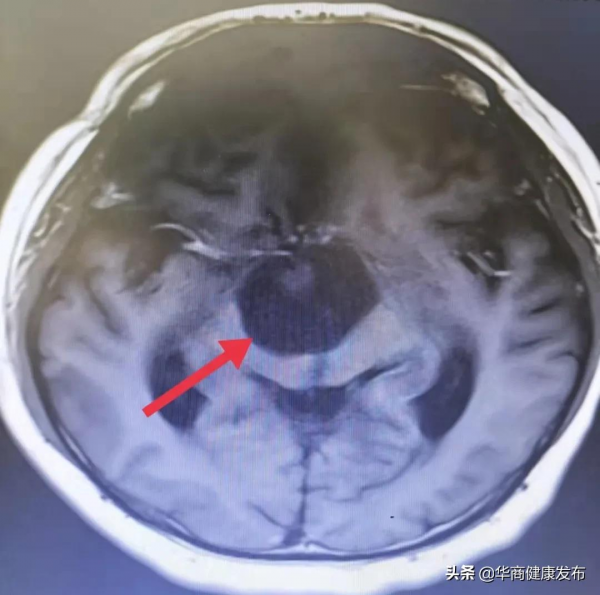 九年之後再次復發！專家為患者無切口切除高死亡率腫瘤
