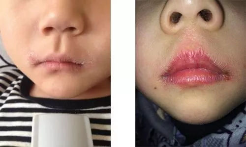 冬季來臨，嬰幼兒進入口角炎的高發季，醫生：3點原因，點破真相