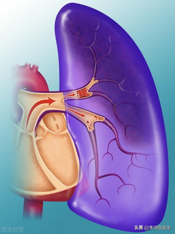 男子發熱2周，心臟發現贅生物，醫生看到雙手上“疹子”：要報警