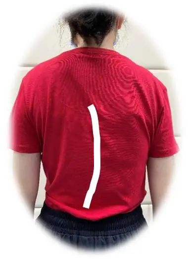 簡單辨別脊柱側彎,避免孩子走“彎”路 簡單辨別脊柱側彎,避免孩子走“彎”路