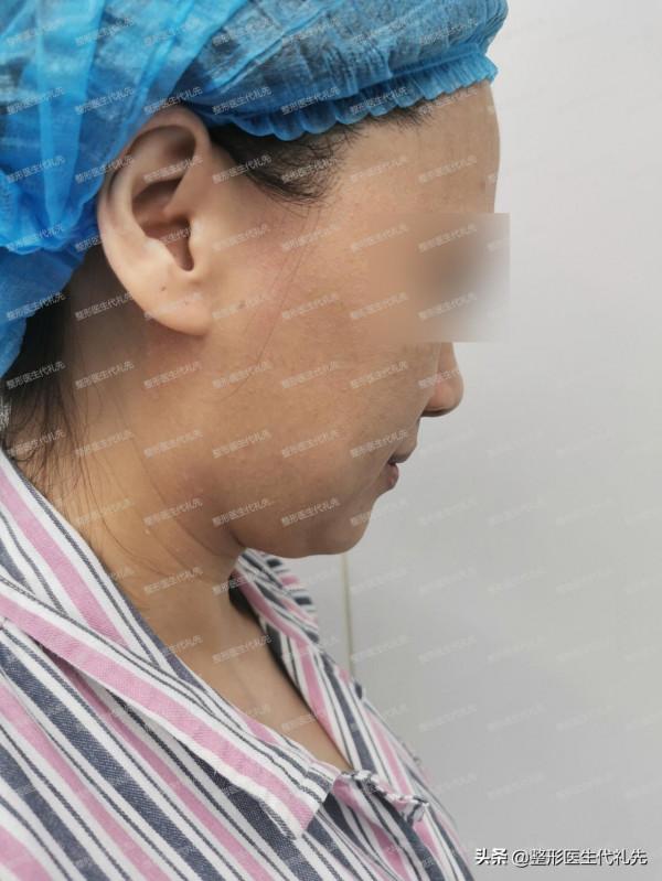 講講我在北京做“微創小切口面部提升”的親身經歷和感受