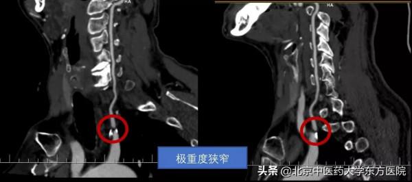 【醫學小常識】有一種眩暈需要格外注意