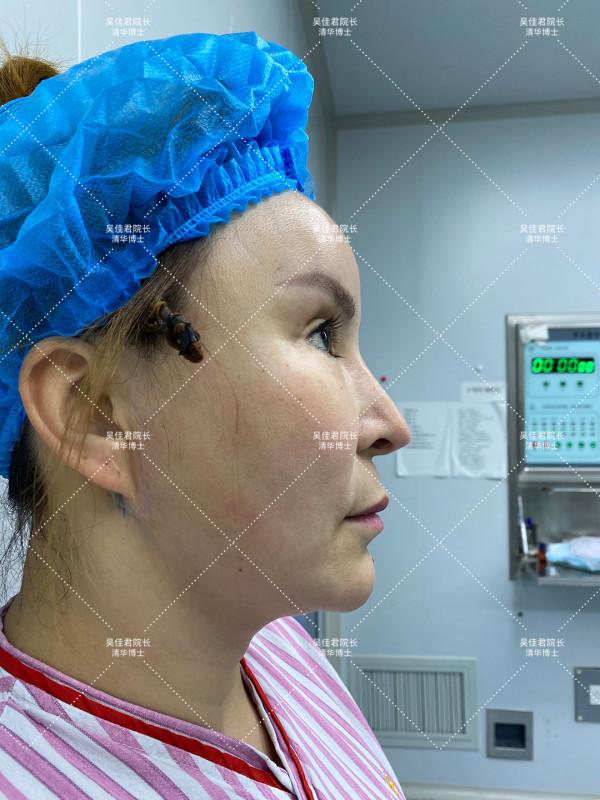 40多歲做小拉皮真實經歷,術後6個月效果很驚豔 40多歲做小拉皮真實經歷,術後6個月效果很驚豔