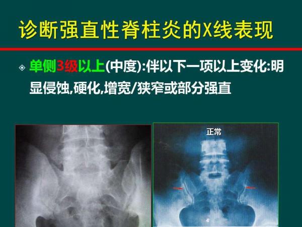 強直性脊柱炎可以丟掉手裡的藥了！半小時PRP軟骨修復治療病情