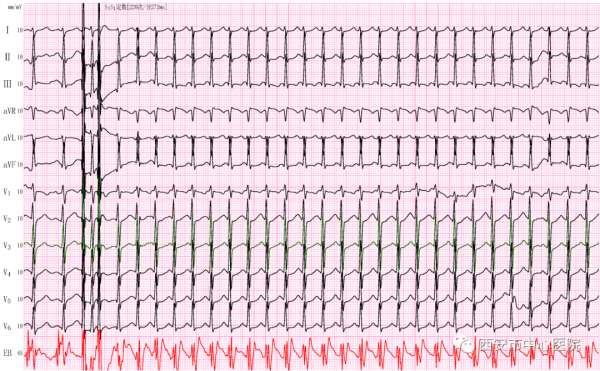 “食道心電圖、食道調搏” 您瞭解嗎? “食道心電圖、食道調搏” 您瞭解嗎?