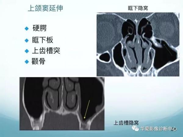 頭頸五官CT斷層解剖圖及常見病影像診斷