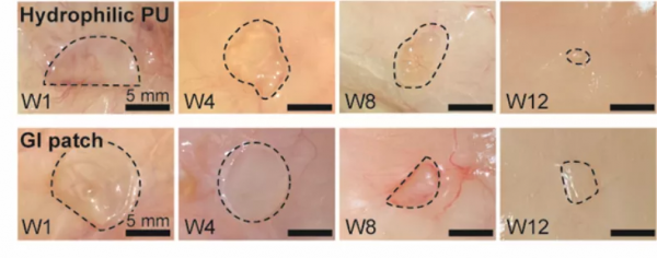 華科校友研發可降解&OpenCurlyDoubleQuote;腸道創可貼&rdquo;，能用於胃腸道缺損無縫修復