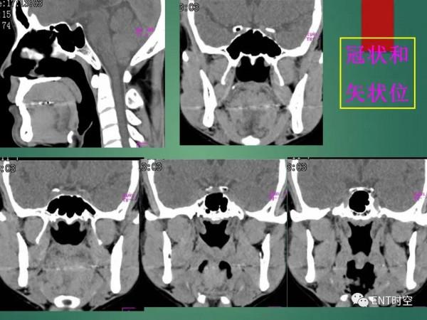 頭頸五官CT斷層解剖圖及常見病影像診斷
