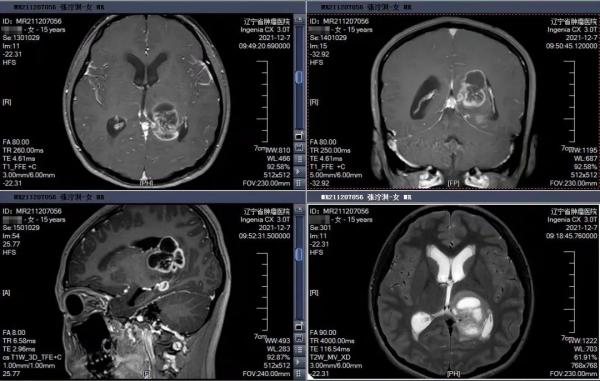 東北地區首例！機器人手術顯微鏡聯合鏡下導航賦能 顯微神經外科手術步入精準切除時代