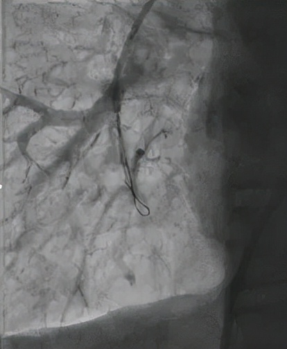 一個腸息肉切除小手術,發現更大致命“隱患” 一個腸息肉切除小手術,發現更大致命“隱患”