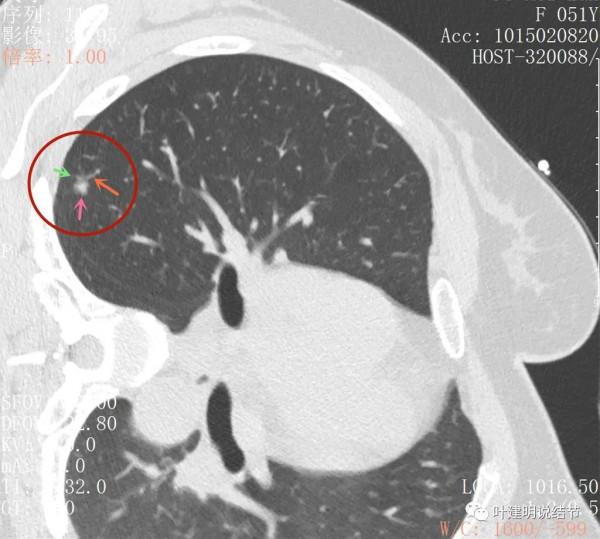 指南說小於5毫米的肺結節不需要隨訪，打臉來了
