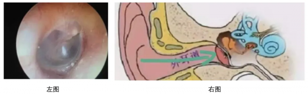 孩子耳朵痛，要警惕什麼？不只是中耳炎，這樣做孩子少遭罪