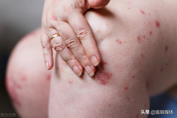 為何會患上牛皮癬？4大常見誘因，要小心防範