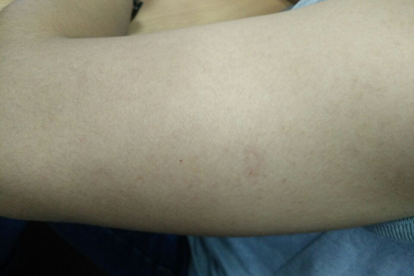 過敏體質的人患癌風險低，有科學依據嗎？明說：易患癌的人有共性
