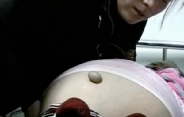 還記得那個得“怪病”肚子大過孕婦的山西女童嗎？後來治好了嗎？