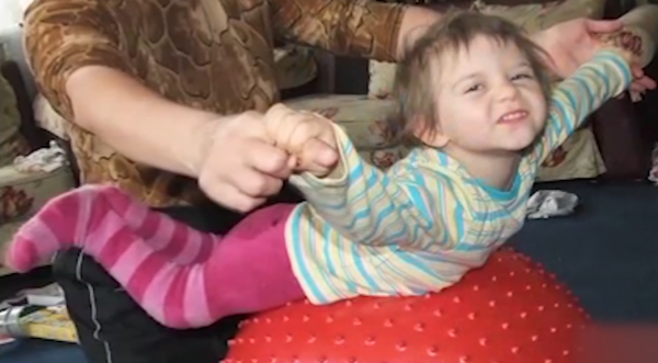 外國女孩天生雙腿畸形，頂級醫院稱無法治癒，結果被中醫3月看好