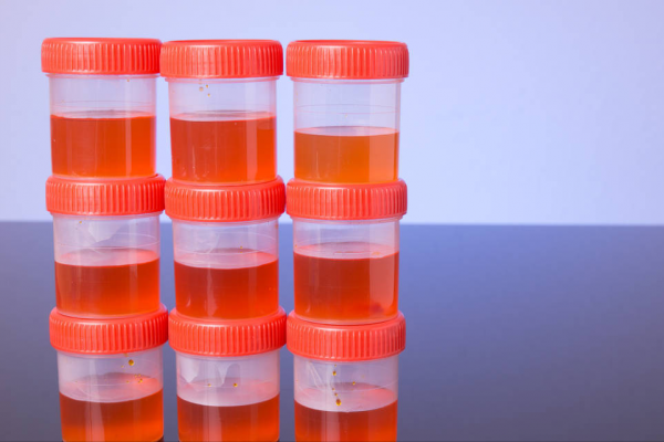 要想早發現腎病,除了定期體檢之外,人們不能忽視這5大異常表現 要想早發現腎病,除了定期體檢之外,人們不能忽視這5大異常表現