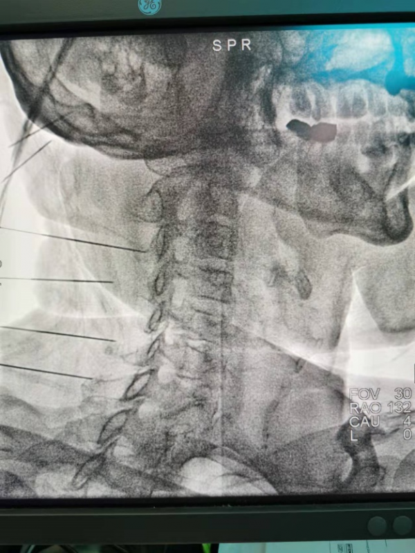 因為頭痛，他每天喝7大杯咖啡，吃50片阿司匹林……