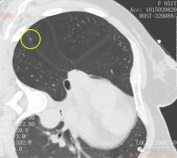 指南說小於5毫米的肺結節不需要隨訪，打臉來了