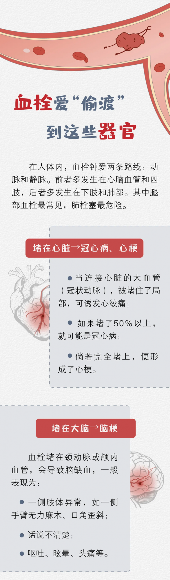 一塊「血栓」的危險漂流之旅 一塊「血栓」的危險漂流之旅
