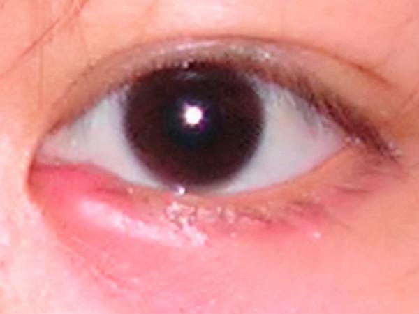 眼周小疙瘩 區別對待它