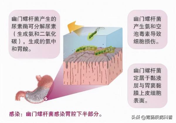 幽門螺桿菌根治方案