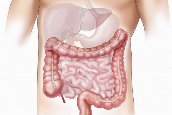 久坐不動、高脂飲食，男性更容易罹患腸癌