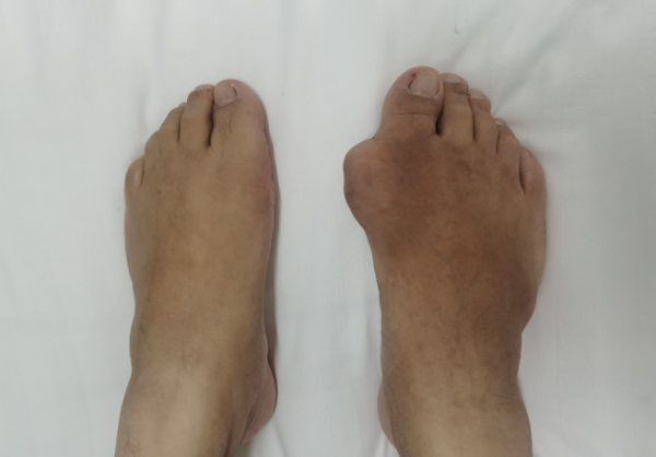 痛風15年不忌口，右腳長滿痛風石！日常3注意，把尿酸“治”服帖