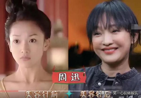 被“美容針”摧殘的女星，戚薇笑都不自然，舒暢真成“天山童姥”