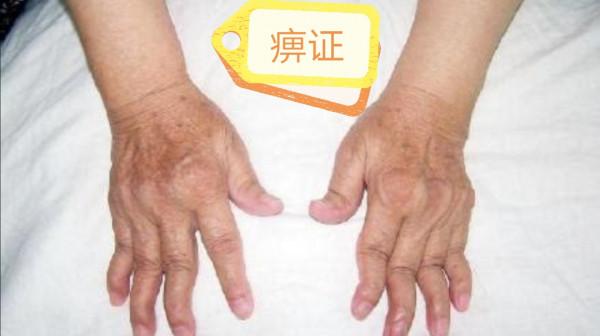 關節疼痛、僵硬，中醫有辦法，助您身手矯健、筋骨強勁