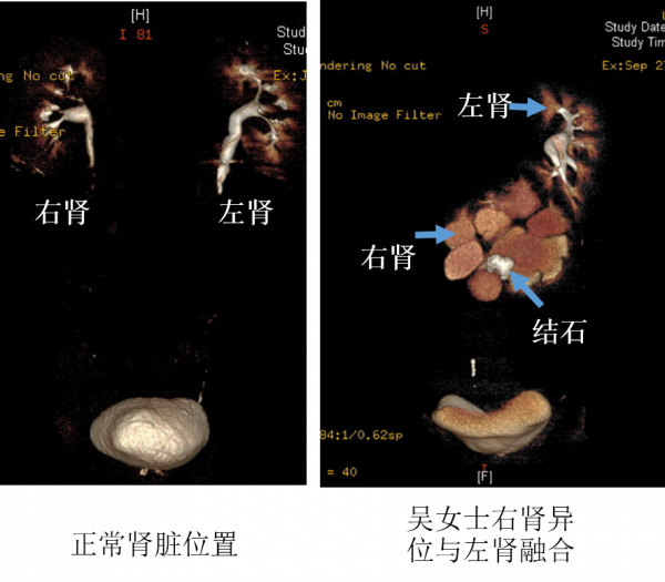 不走尋常“路” 清華長庚泌尿外科為異位腎患者解除腎結石