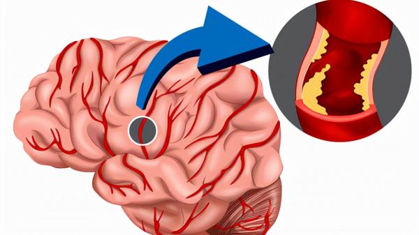 研究發現：這種&OpenCurlyDoubleQuote;小零食&rdquo;或是血管&OpenCurlyDoubleQuote;清理劑&rdquo;，常吃，預防血栓