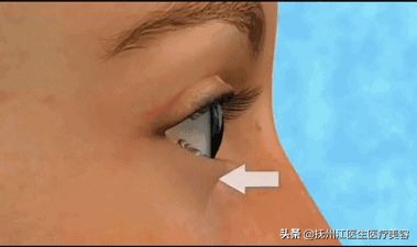 科普篇丨眼袋很重怎麼解決？