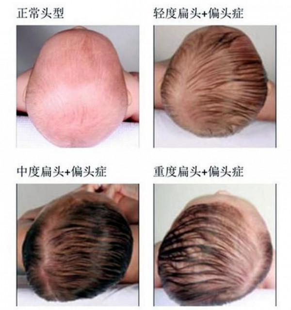 “扁頭”最扁能有多誇張？女孩曬照自嘲，圓頭才是孩子的福氣