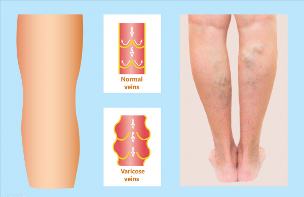 通塞脈片,活血通絡、益氣養陰,打通閉塞血脈,防治6種微血管病 通塞脈片,活血通絡、益氣養陰,打通閉塞血脈,防治6種微血管病