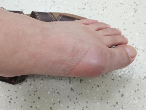 外賣小哥吳風發作痛風，醫院就診經歷（一）